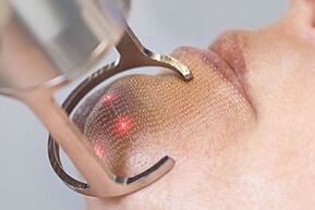 Fractional laser skin rejuvenation technology