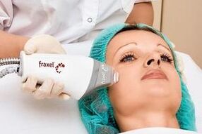 Laser dot facial rejuvenation
