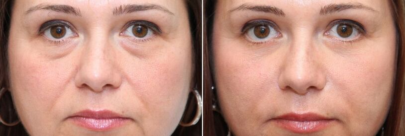 Before and after blepharoplasty - removes the fat body under the eyes and tightens the skin