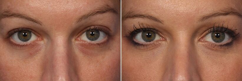 Before and after injectable fillers - reduce eye circles